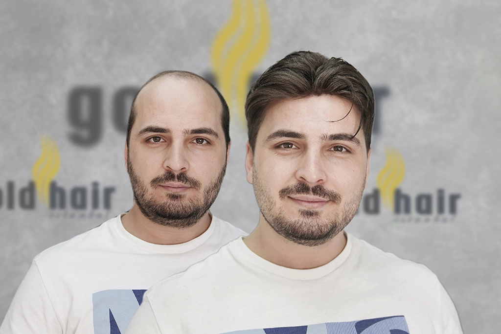 Protez Saç Merkezi - Gold Hair İstanbul