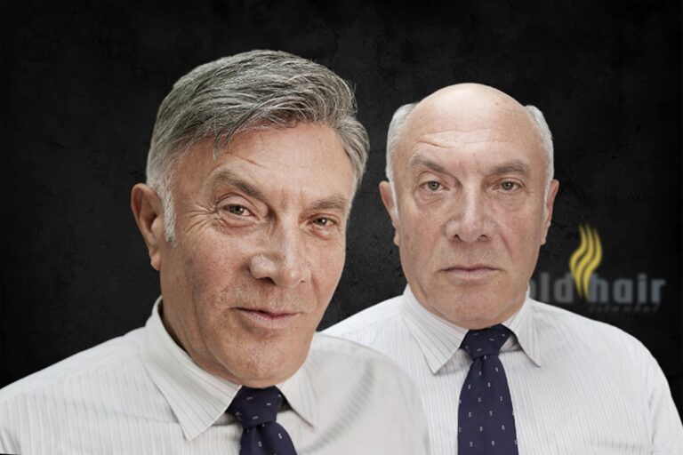 protez saç