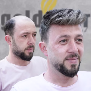 Protez Saç Uygulaması Protez-Sac-Ve-Saç-Ekimi-Arasındaki-Farklar