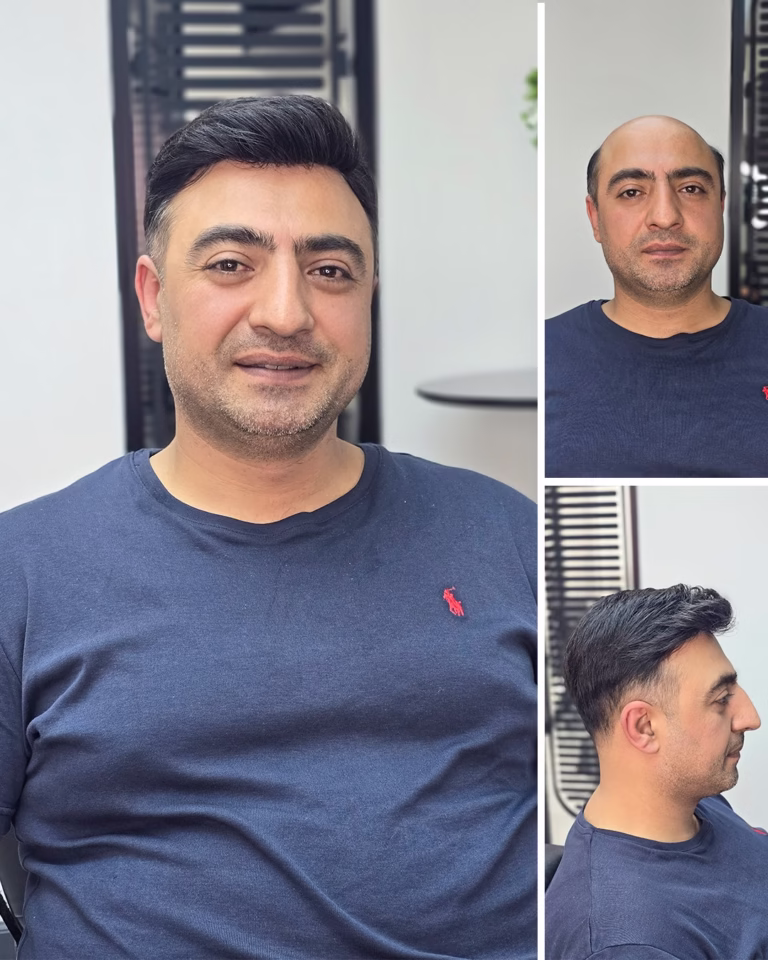 protez saç rehberi