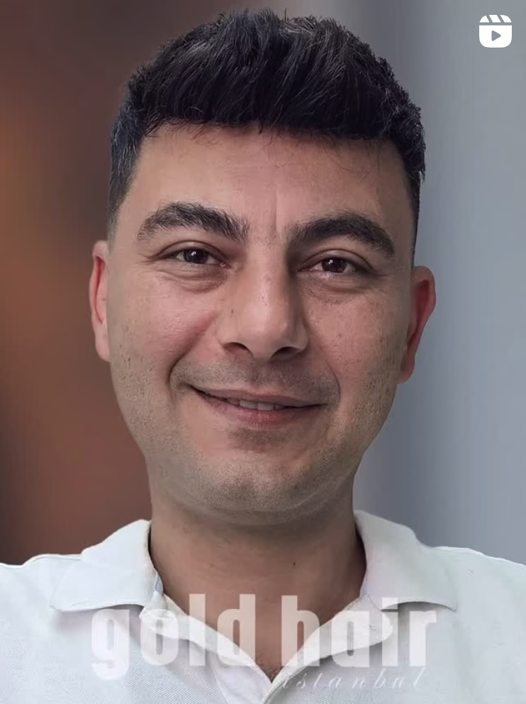 protez saç ile mutlu bir hayat