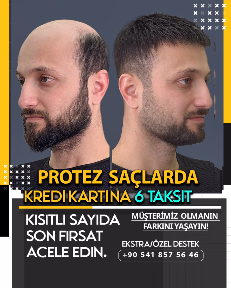 Protez Saç Kullanıcıları İçin Seyahat Rehberi