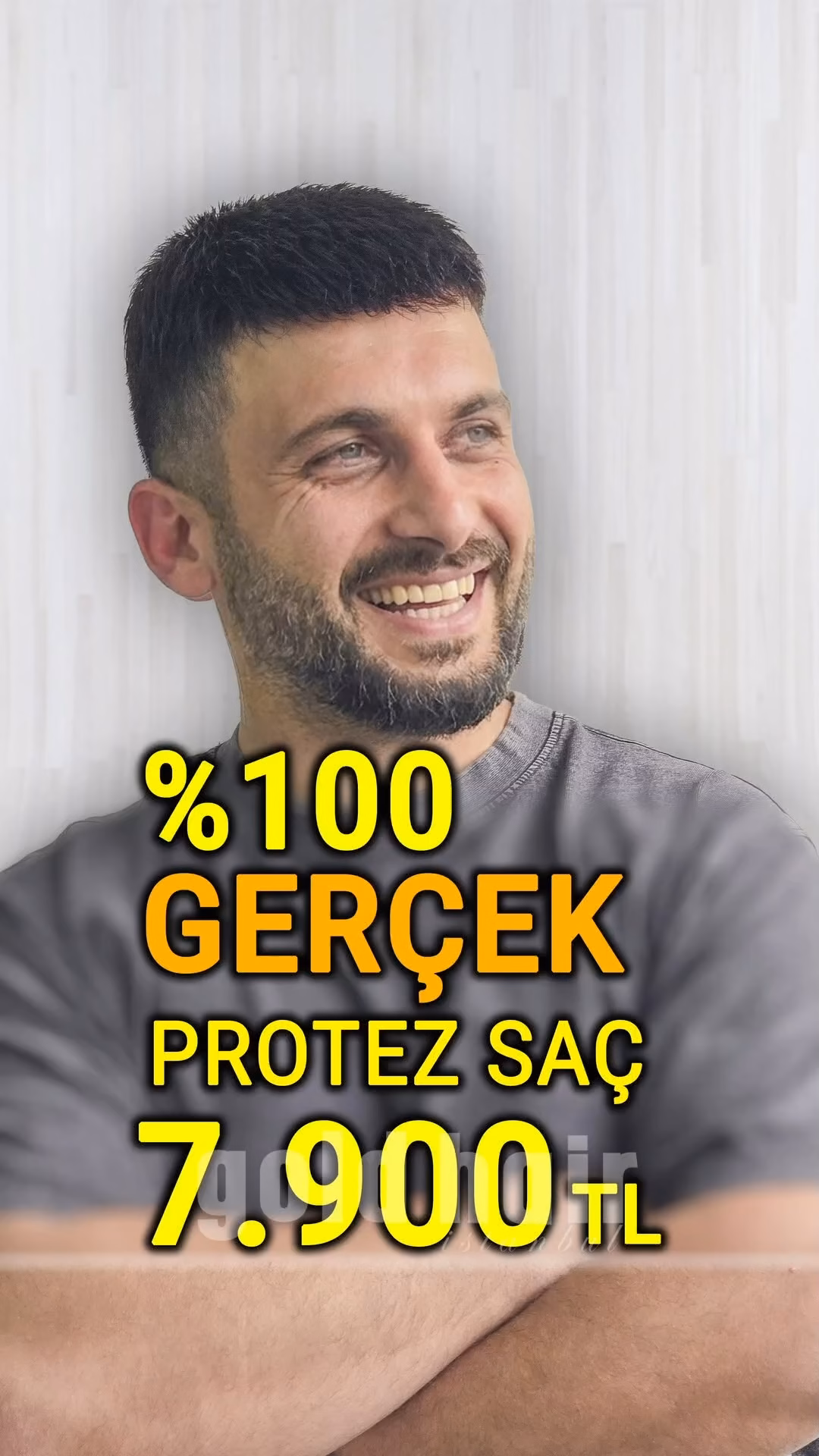 Saç Ekimi Yerine Protez Saç Daha Iyi Bir Seçenektir.