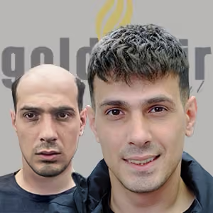 İstanbul Protez Saç Erkek Protez Saç