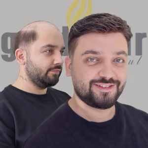 Protez Saç Uygulaması Erkek Protez Saç